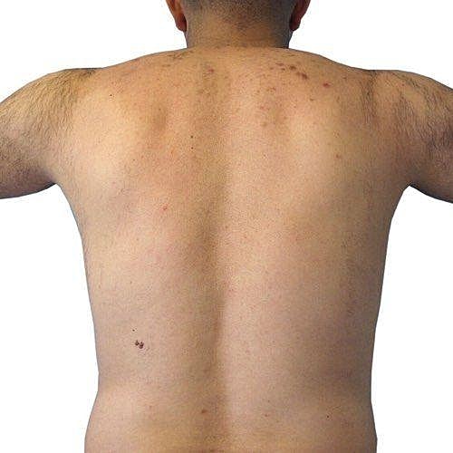 Man's back with skin blemishes and imperfections.