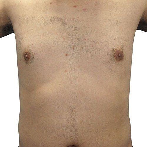 Hairy male torso with visible skin imperfections.